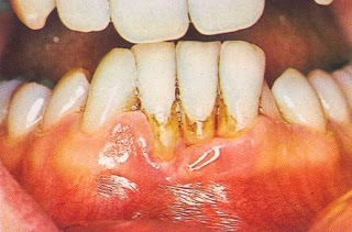 الأعشاب و النباتات كنز لا يفنى Bad-teeth-774317