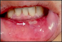 குழந்தைகளுக்கு வரும் வாய் புண் மற்றும் துர் நாற்றம்  P4T2_aphthous_ulcer