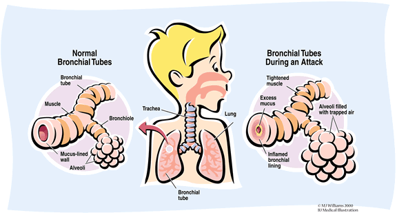 குழந்தைகளுக்கு வரும் ஆஸ்த்மா :  Asthma_lungs