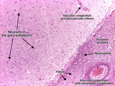 مكتبة الصور الطبية : - باثولوجى -- Pathology slides Purulent_meningitis