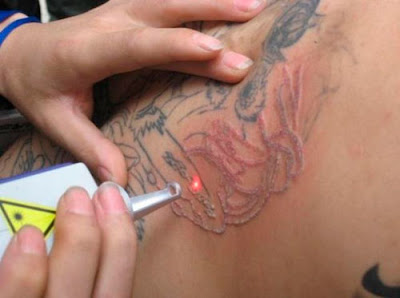 Μπορεί να αφαιρεθεί εντελώς ένα τατουάζ (;) Laser-tatoo-removal