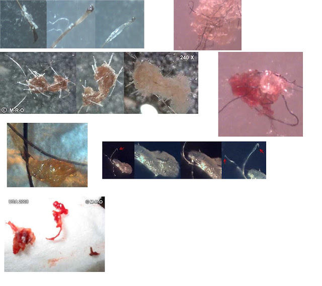 The "Morgellons" Umbrella: What it is or isn't  Morgellons