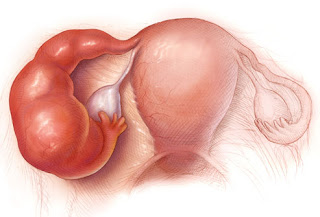 أسباب الالام أسفل البطن عند الاناث Princ_rm_photo_of_pelvic_inflammatory_disease