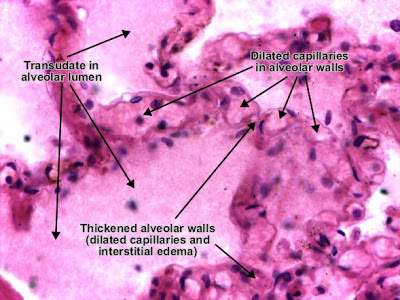 مكتبة الصور الطبية : - باثولوجى -- Pathology slides Pulmonary_edema_detail