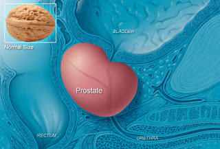 كل مايجب ان تعرفة عن سرطان البروستاتا ( الجزء الاول)... _englarged_prostate