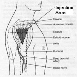 Intramuscular injection "IM" sites,steps,procedure 448339_f260%255B1%255D