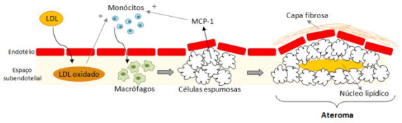 Extensivo sanar- 05 Dislipidemias e fatores de risco para doença cardiovascular Ateroma