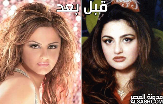 صور الفنانات العرب قبل وبعد عمليات التجميل 7