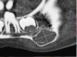 A propos d’une image radio-claire de l’angle mandibulaire chez un enfant de huit ans  4