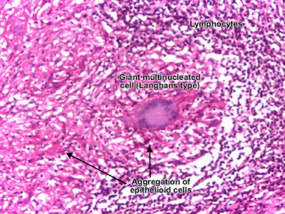 مكتبة الصور الطبية : - باثولوجى -- Pathology slides Tuberculous_lymphadenitis_granuloma_03