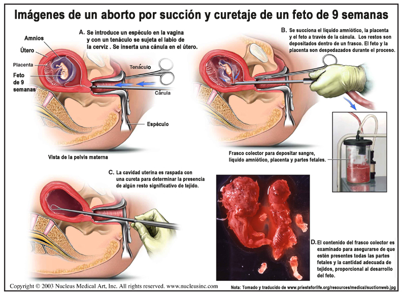 El aborto. ¿Crimen o un derecho? - Página 12 Suctionwebsp