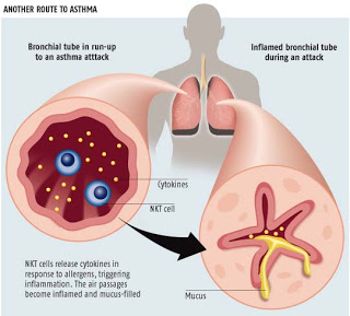 Sistem Pernapasan  Asthma4