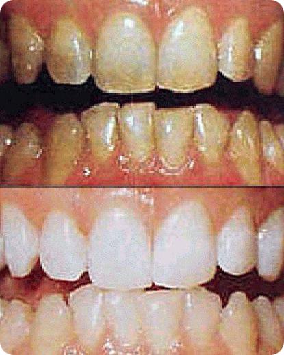 4 طرق لتتخلص من مسببات أصفرار الأسنان 1286008128