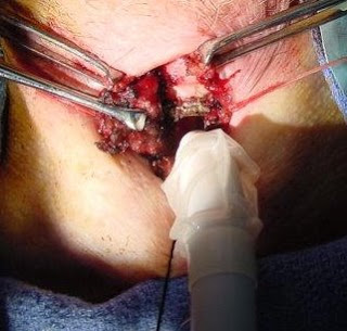 Tracheostomy & Cricothyrotomy بالصور Tracheostomy4