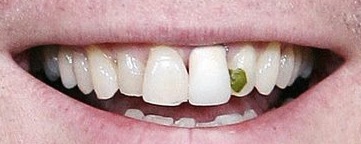 Post a pic of something GREEN. - Page 9 Spinach-in-teeth