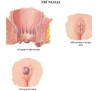  Những triệu chứng nguy hiểm của bệnh trĩ ngoại Trieu-chung-cua-benh-tri-ngoai