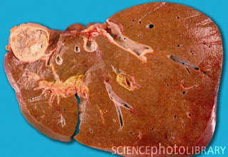 الاطوار اليرقية للديدان الشريطية في الاغنام بالصور M1700410-Hydatid_cyst_of_liver-SPL