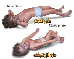 ما هو الصرع ؟ Seizuredisorders