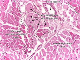 مكتبة الصور الطبية : - باثولوجى -- Pathology slides Acute_myocardial_infarct