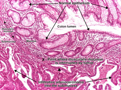 مكتبة الصور الطبية : - باثولوجى -- Pathology slides Moderatelly_differentiated_adenocarcinoma_colon