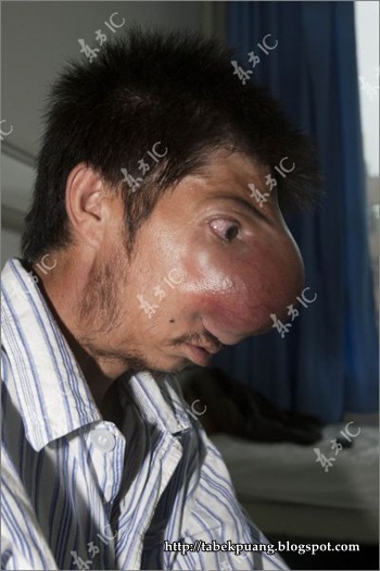 Hidung Manusia Terbesar di dunia The_man_with_640_06