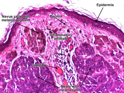 مكتبة الصور الطبية : - باثولوجى -- Pathology slides Intradermal_melanocytic_nevus_detail