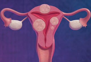 أسباب الالام أسفل البطن عند الاناث Phototake_rm_photo_of_uterine_fibroids