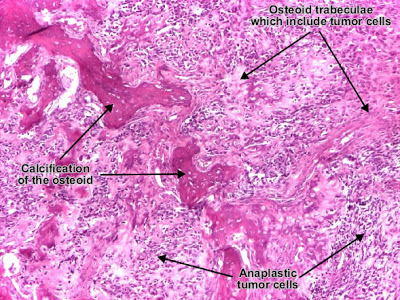 مكتبة الصور الطبية : - باثولوجى -- Pathology slides Osteosarcoma_osteogenic_sarcoma_02