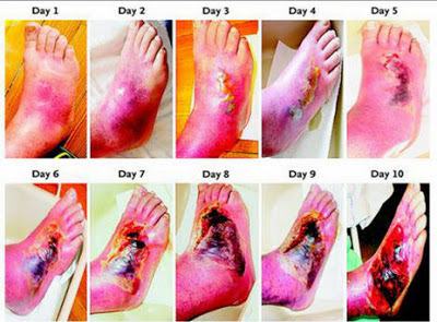 Never take a risk with your feet Diabetes_foot_480_19a27ot-19a27p2