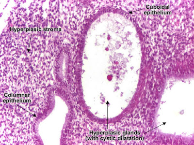 مكتبة الصور الطبية : - باثولوجى -- Pathology slides Endometrial_simple_typical_hyperplasia_detail