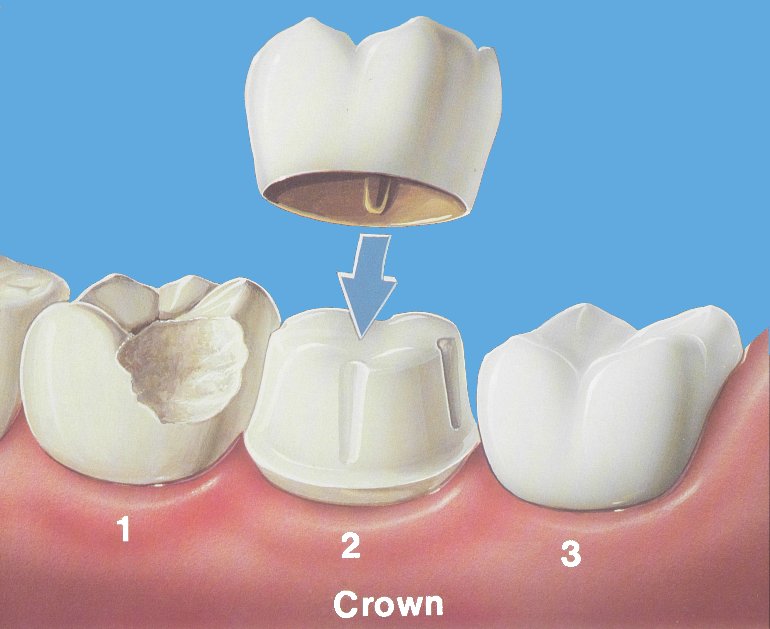  إصابات الأسنان(الإسعافات الإولية) Crown_place