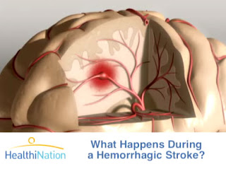 علاج الجلطة الدماغية Stroke.3DAnimation.brain.so