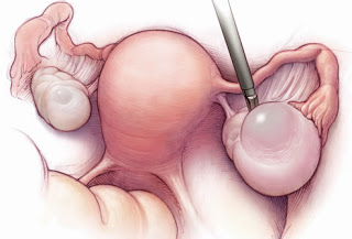 أسباب الالام أسفل البطن عند الاناث Phototake_rm_photo_of_ovarian_cysts