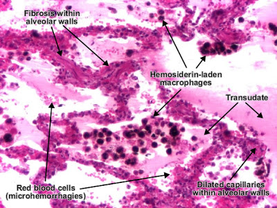 مكتبة الصور الطبية : - باثولوجى -- Pathology slides Passive_congestion_hyperemia_lung