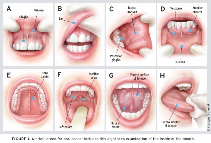 வாய் புற்றுநோய் அறிகுறிகள் தடுக்கும் முறைகள்  ORALCANCER_EXAM