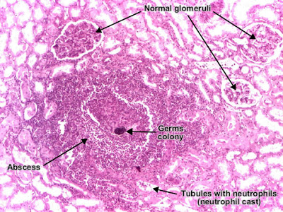 مكتبة الصور الطبية : - باثولوجى -- Pathology slides Acute_pyelonephritis_01