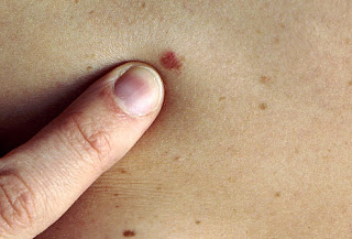  كيف تكتشف سرطان الجلد ب3 طرق سهلة .. 10