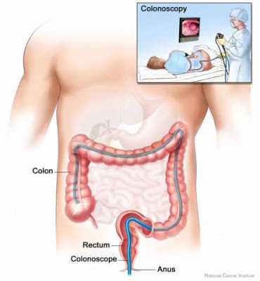 التهاب القولون التقرحي لا تتجاهل أعراضه 554px-Colonoscopy_qjpreviewth