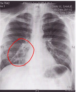 Sistem Pernapasan  X-ray-bronchitis1