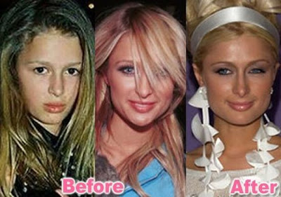 ПРЕД И ПОТОА Stars_plastic_surgery_32