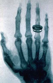 صور الأحداث التاريخية التي تغير العالم 180px-Roentgen-x-ray-von-kollikers-hand