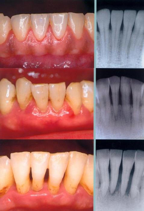 أمراض اللثة  ((Diseases of the gum)) 8767_1184798013