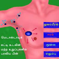 மார்பகப் புற்றுநோய் பற்றி விவரங்கள் - 2  Stage4