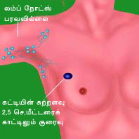 மார்பகப் புற்றுநோய் பற்றி விவரங்கள் - 2  New%2520Stage1