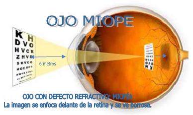 ¿Qué es la miopía? 57_Ojo_miope