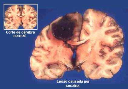 LAS DROGAS DESTRUYEN TU VIDA  : Peyote , Hayahuasca , Cocaína LSD , y otras . Por Sahú Ari Merek. - Página 2 Cocaina9