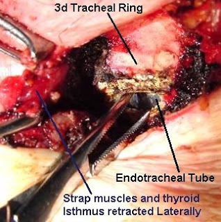 Tracheostomy & Cricothyrotomy بالصور Tracheostomy3