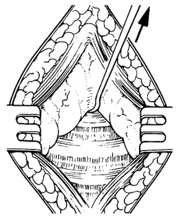 Tracheostomy & Cricothyrotomy بالصور 16.17