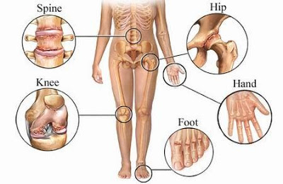 மூட்டுவலி‌யினா‌ல் முட‌ங்க வே‌ண்டா‌ம் Chronic-joint-pain1