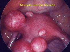 கருப்பை கட்டிகள் ! Multiple_uterine_fibroids